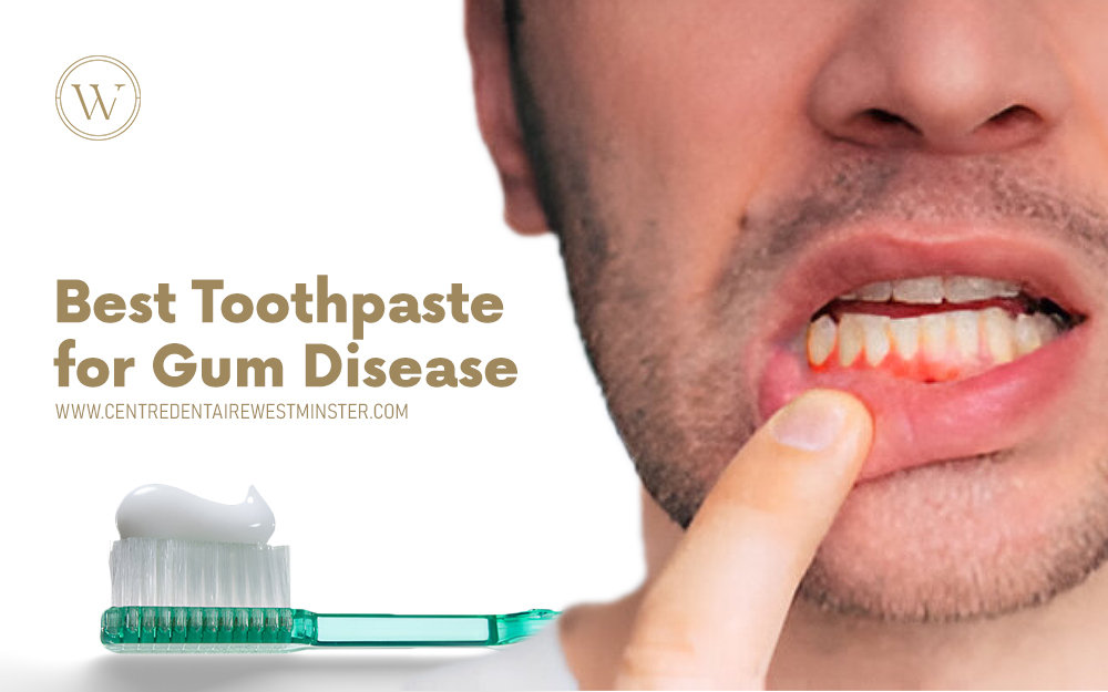 Best Toothpaste for Bleeding Gums and Cavities