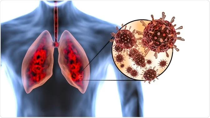 How to Improve Lung Function After COVID – Easy Tips for Better Breathing