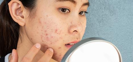 How to Get Rid of Adult Acne Naturally