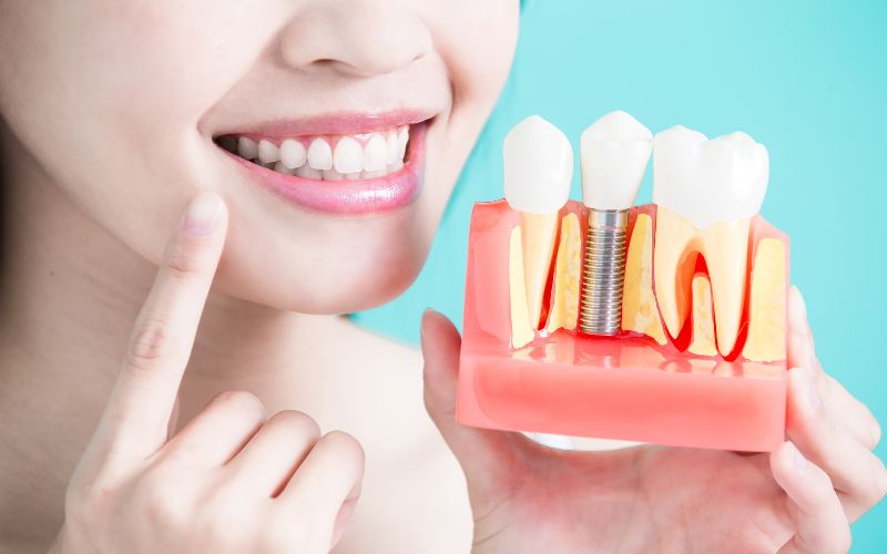Dental Implants: What to Expect Before, During, and After the Procedure