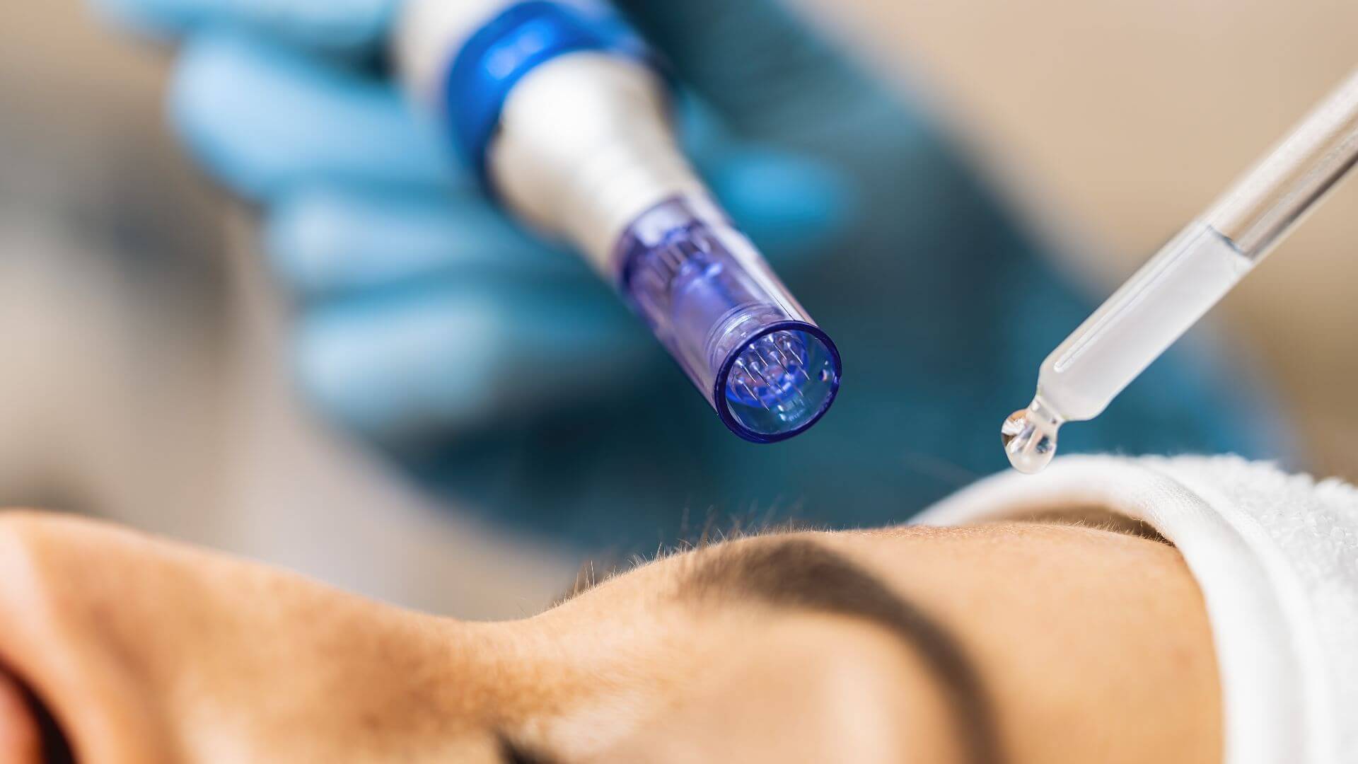 Microneedling: How It Reduces Fine Lines and Wrinkles