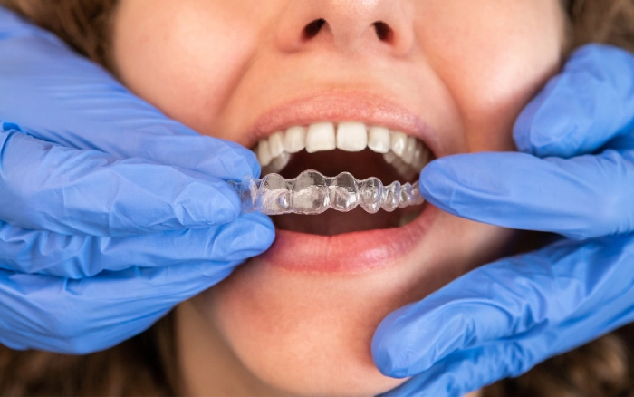 How Does Invisalign Work?