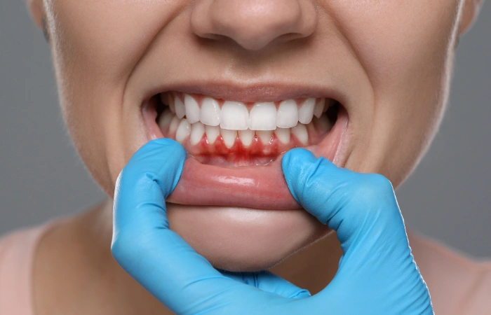 The Role of Teeth Cleaning in Preventing Gum Disease