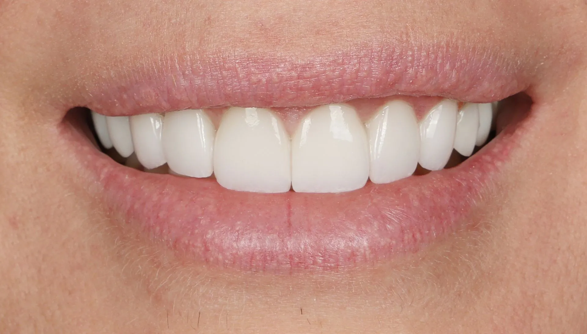 What To Know About the Process of Getting Veneers