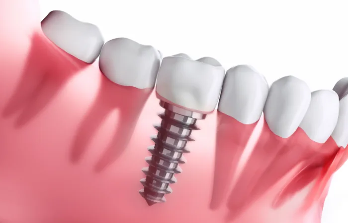 Exploring the Benefits of Dental Implants