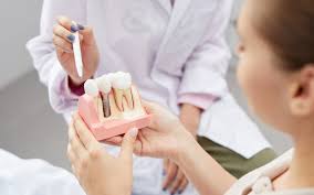 Understanding the Benefits of Dental Implants for Long-term Oral Health