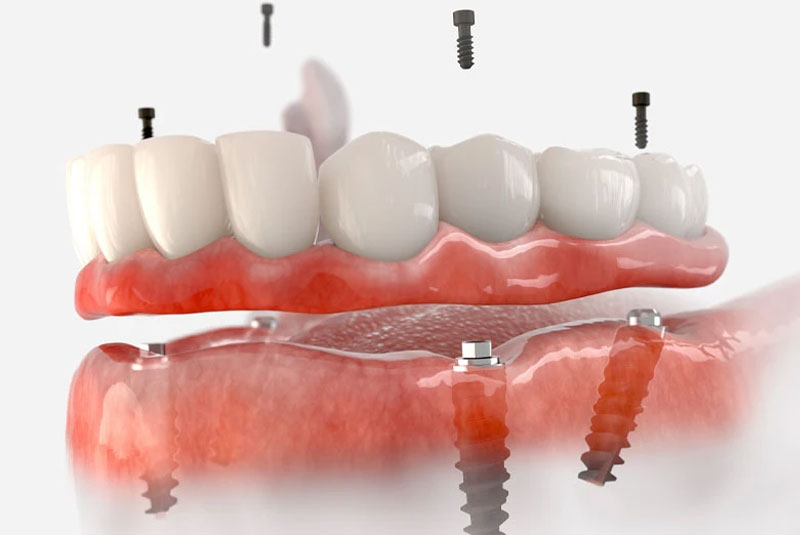 Understanding the Different Types of Dental Implants Available