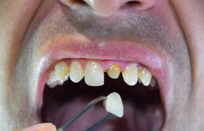 Identifying and Treating Cracked Teeth