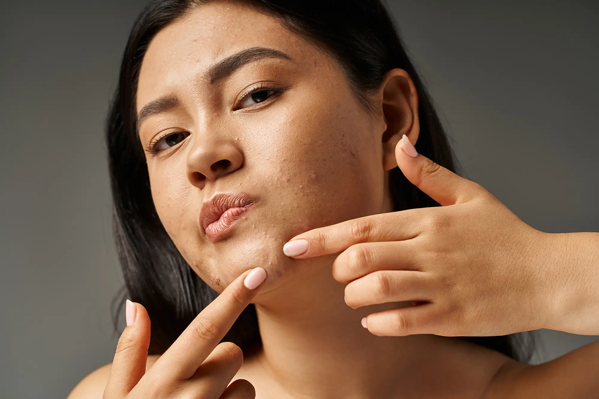 The Connection Between Diet and Acne