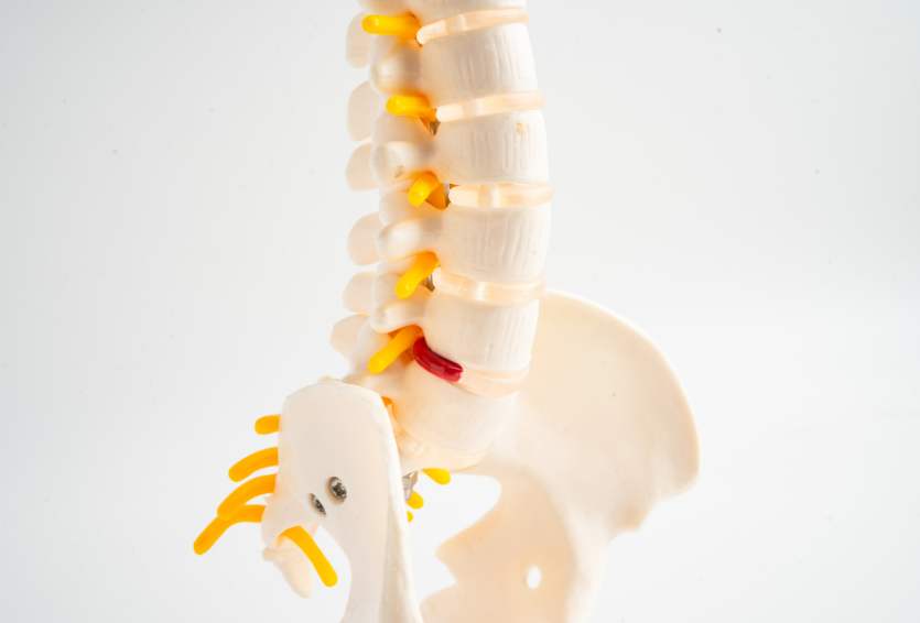 What Patients Need to Know About Minimally Invasive Spinal Fusion
