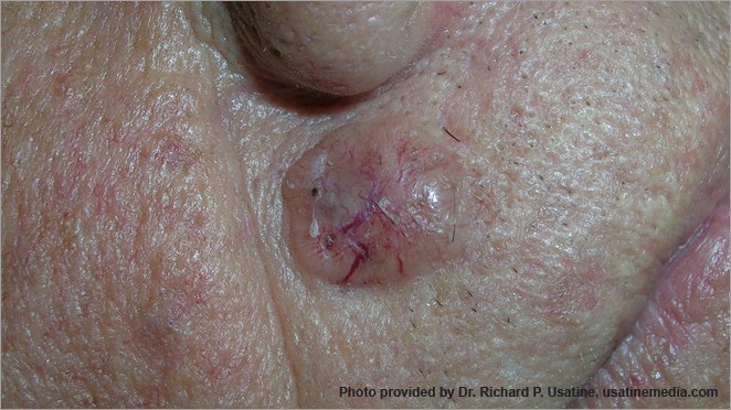 Early Signs of Skin Cancer and What To Look For
