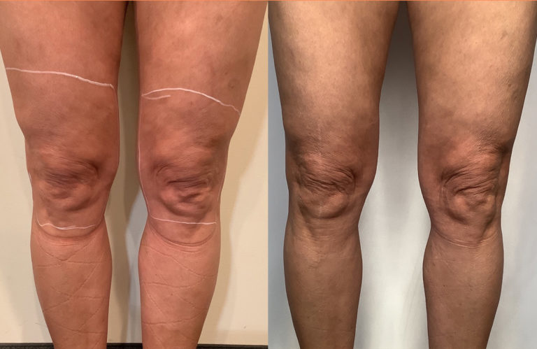 How To Address Wellness When Dealing With Varicose Veins