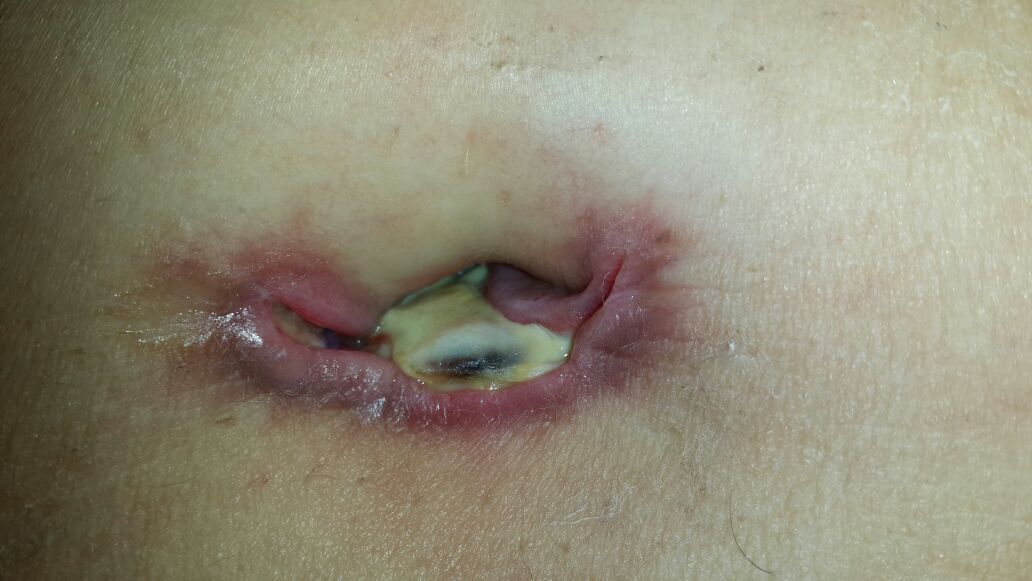 How to Know When You Need Hernia Surgery