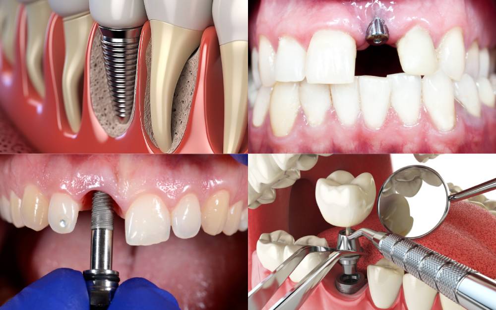 The Advantages of Dental Implants Over Traditional Dentures