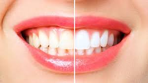 The Benefits of Professional Kor Whitening for Your Smile