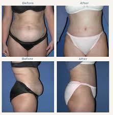 The Connection Between Weight Loss and Tummy Tuck Surgery