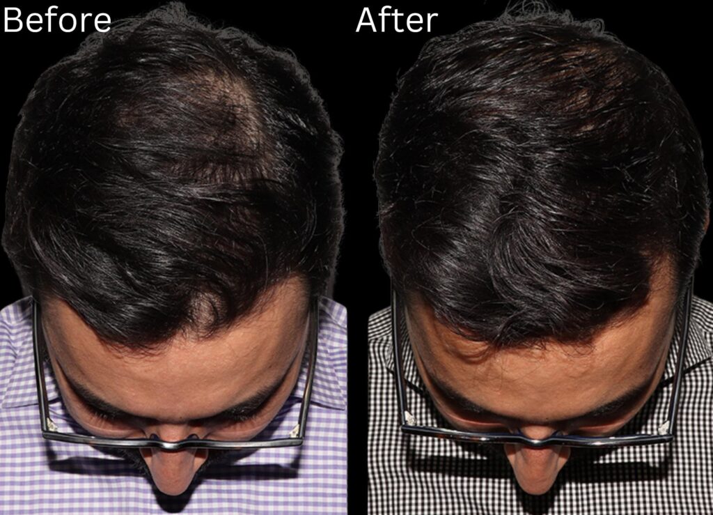 The Future of Hair Loss Treatments