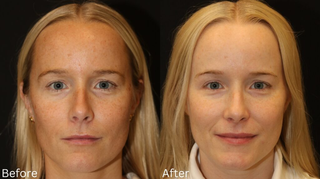 The Relationship Between Skin Cancer and Indoor Tanning