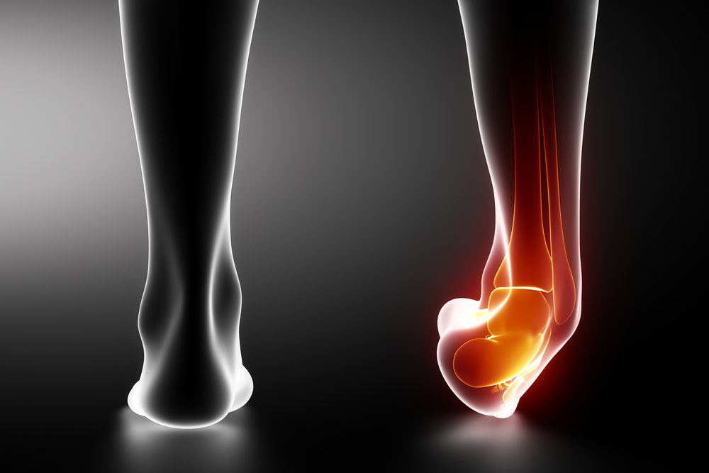 The Role of Early Intervention for Ankle Sprains