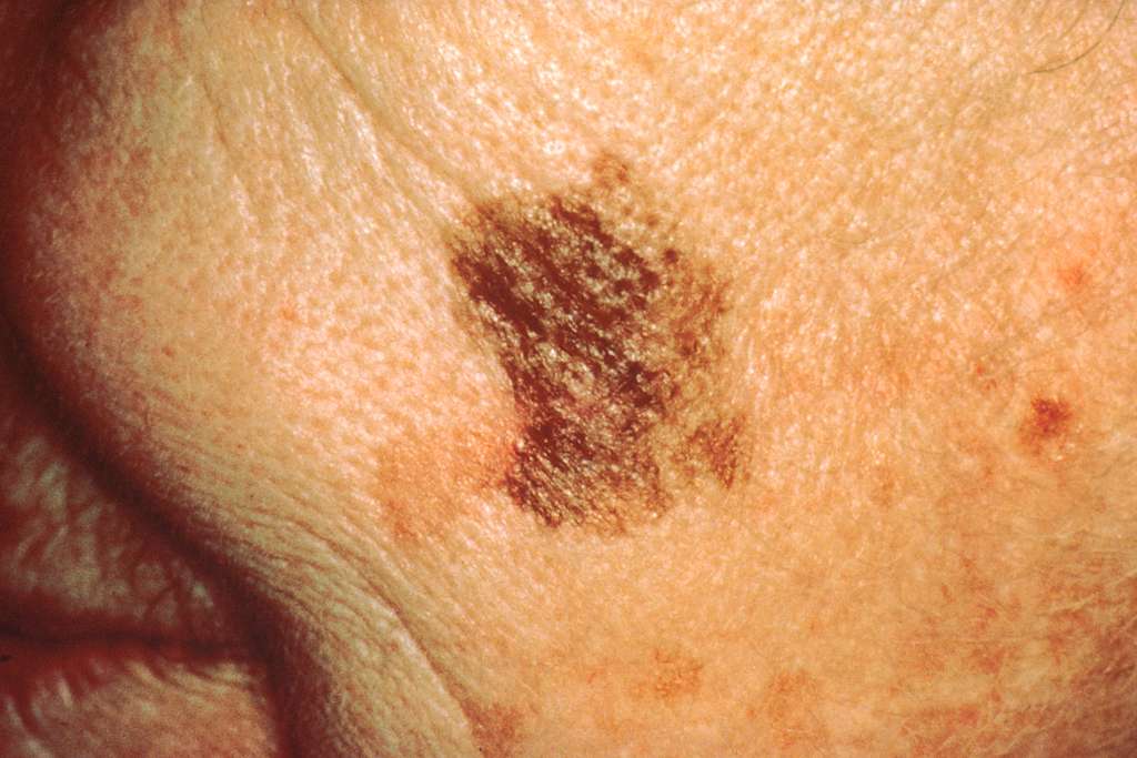 Understanding the Different Stages of Melanoma Understanding the Different Stages of Melanoma