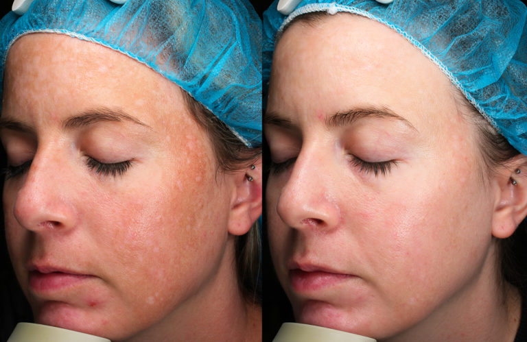 What To Know About Microneedling and Skin Texture