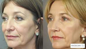 What To Know Before Getting Plastic Surgery