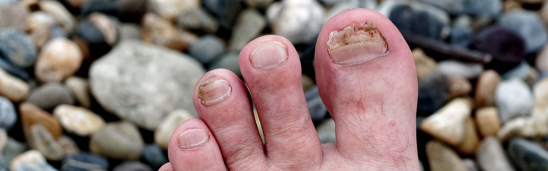 When To See a Specialist for Ingrown Toenails